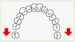 奥歯の遠心への移動イメージ