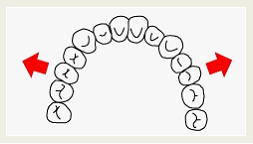 歯列弓の側方への拡大イメージ