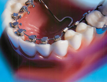 リンガル（舌側・裏側）矯正装置経験者へのアンケート結果（舌側矯正学会より）イメージ