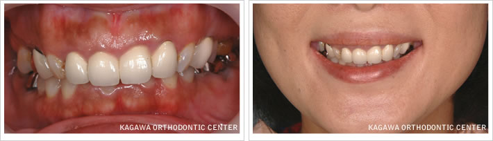 包括的歯列矯正治療症例2