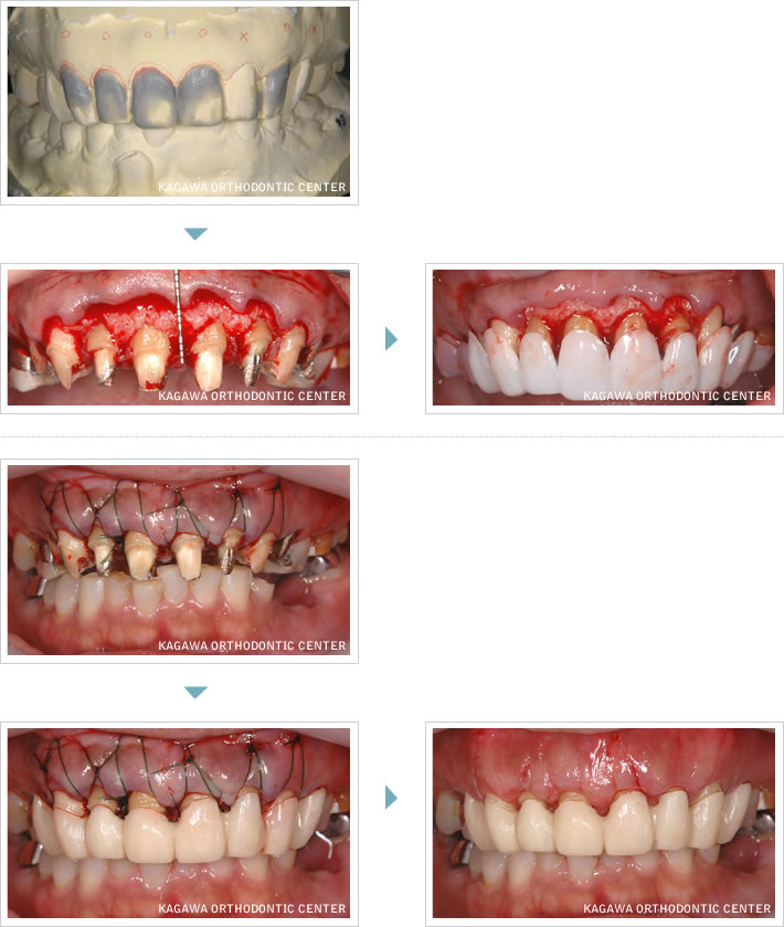 上顎前歯の歯周外科（歯茎ラインの修正）例1