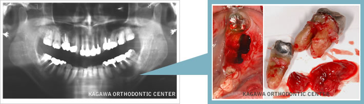 左下臼歯部のう胞摘出手術 例1