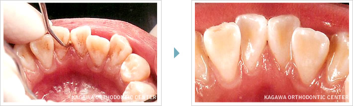 歯石除去イメージ2