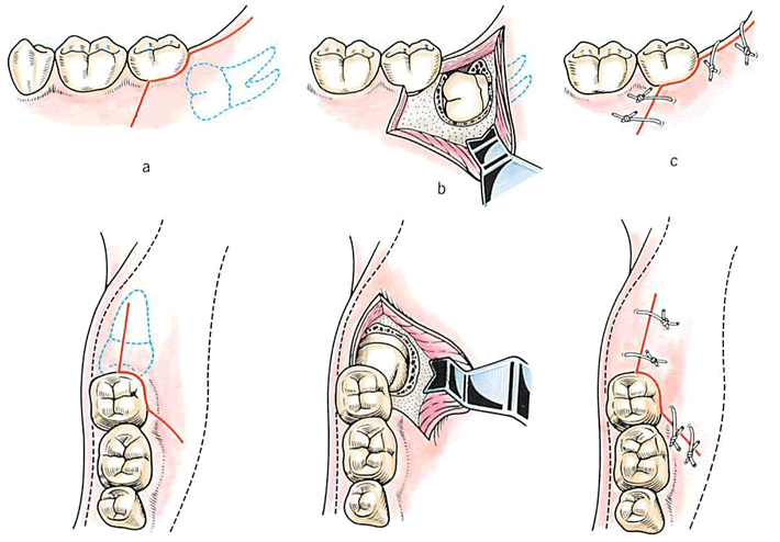 親知らずが粘膜下に隠れている場合の抜歯手順　（a→c）イメージ