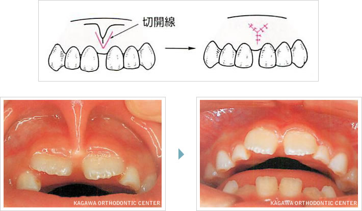 （1）　上唇小帯が前歯の間まで延びている場合（上唇小帯短縮症）イメージ