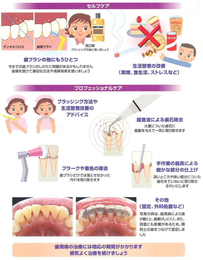 歯周病はどうしたら治るの？イメージ