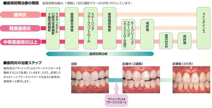 歯周病全体の流れイメージ