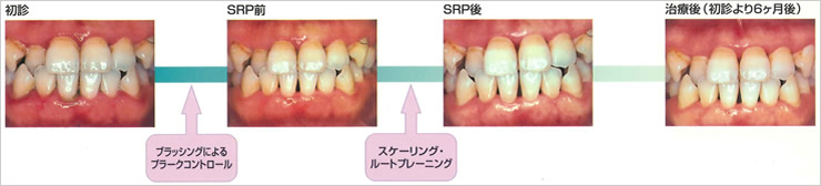 中等度歯周炎の治療ステップイメージ
