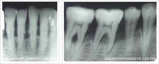 歯周病の進行により骨支持が失われたレントゲン像