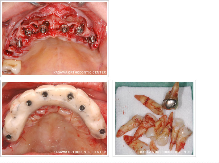 抜歯即時負荷インプラント手術（上顎）症例写真