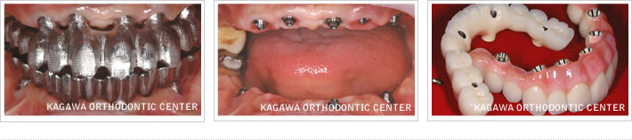 抜歯即時負荷インプラント手術（下顎）症例３