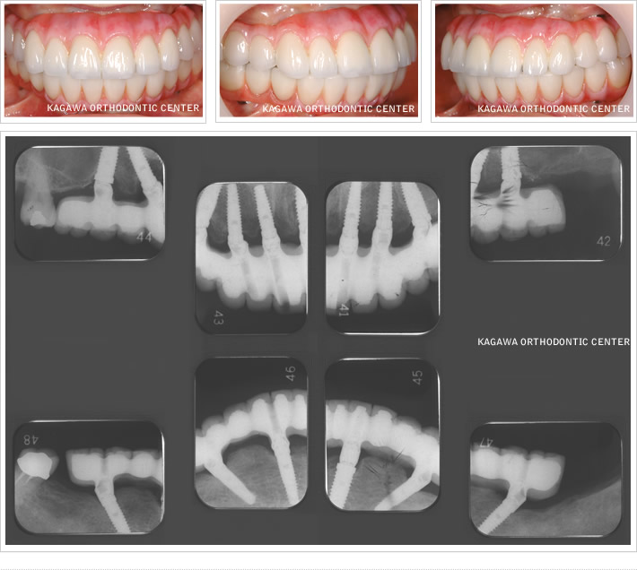 抜歯即時負荷インプラント手術（下顎）症例４