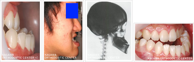 下顎後退手術の一術式イメージ