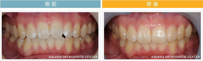 【25歳女性】上の前歯の限局矯正（動的治療期間6ヶ月）
